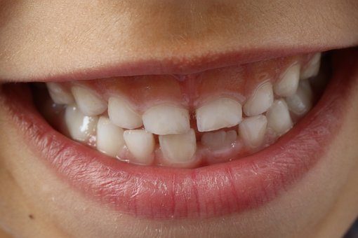 6 Reasons to Get a Dental Crown