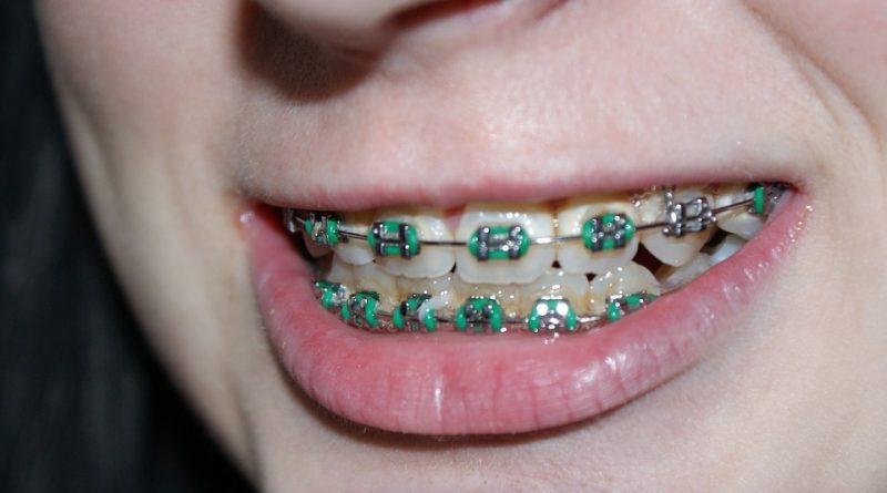 Dental Braces